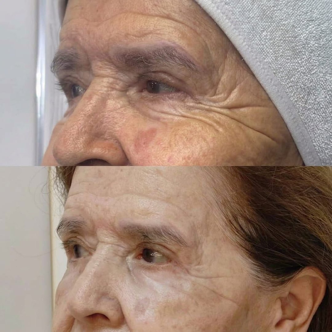 Antes y después de Endolifting: contorno de ojos