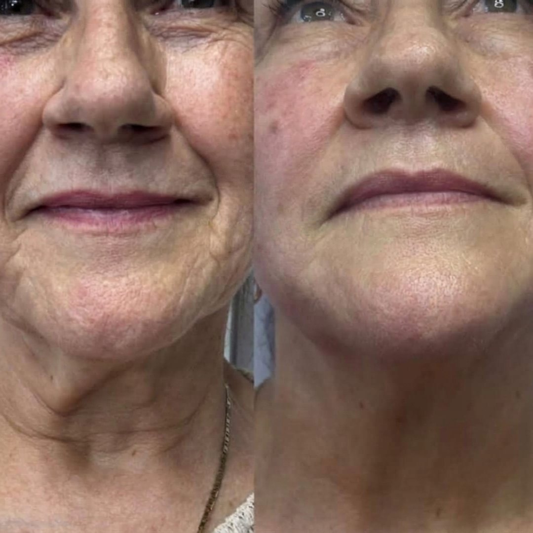Antes y después de Endolifting: óvalo facial y cuello
