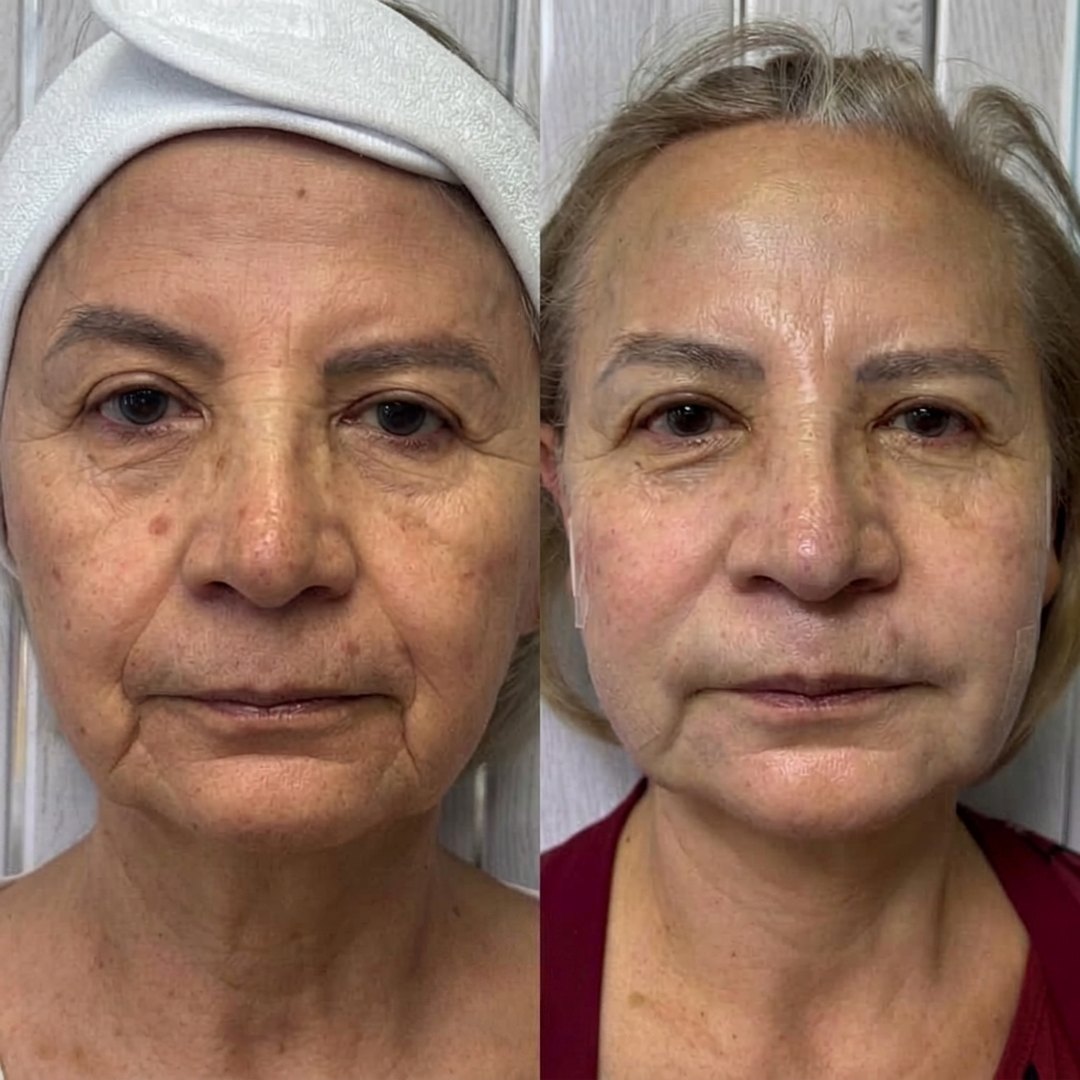 Antes y después de Endolifting: flacidez y líneas de expresión